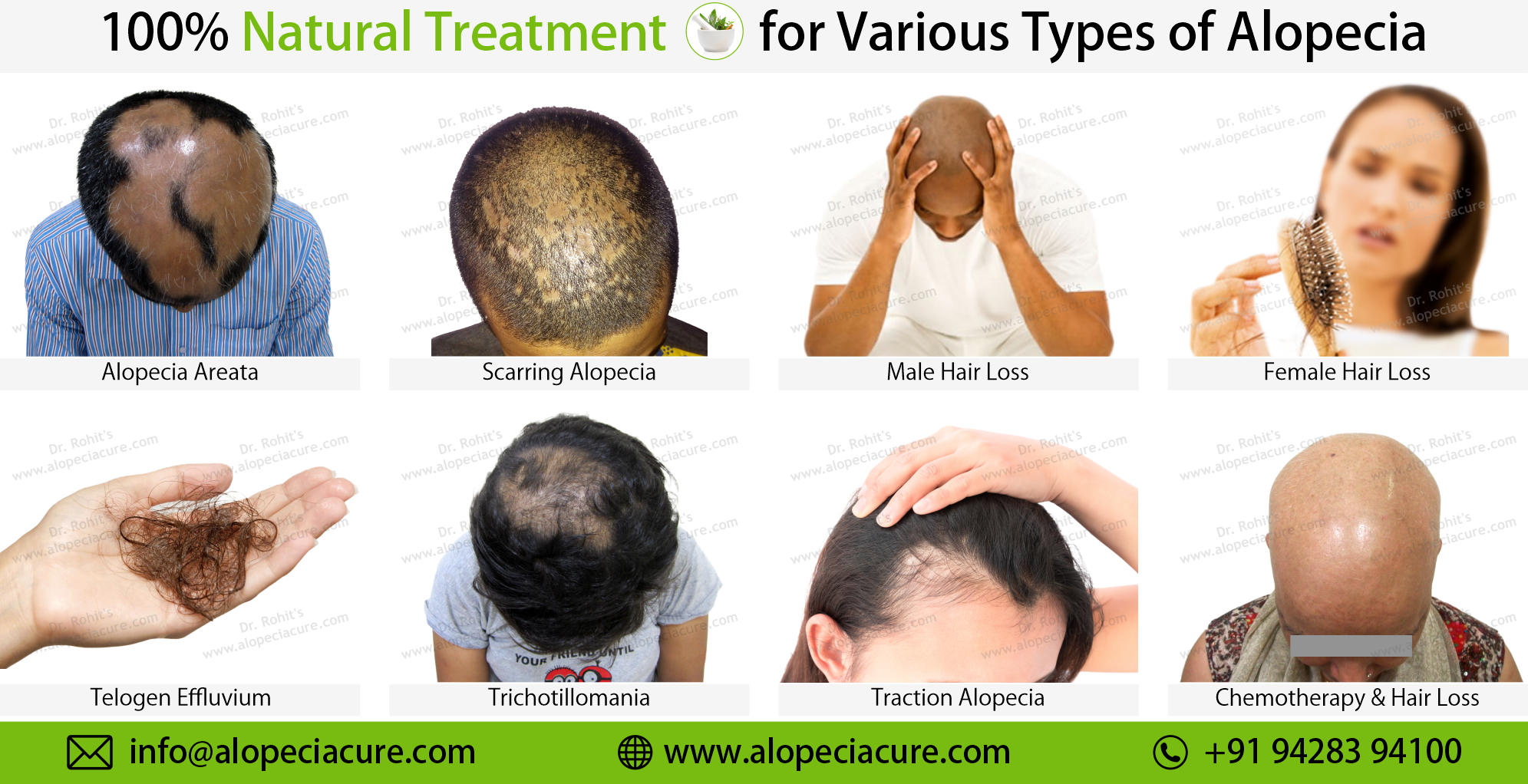 Alopecia Areata Natural Treatment Overview